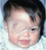 Amblyopia lazy eye