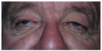 eye lid problems