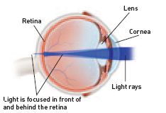 Refractive Errors