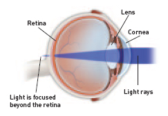 Refractive Errors