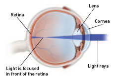 Refractive Errors