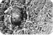 selective laser trabeculoplasty slt
